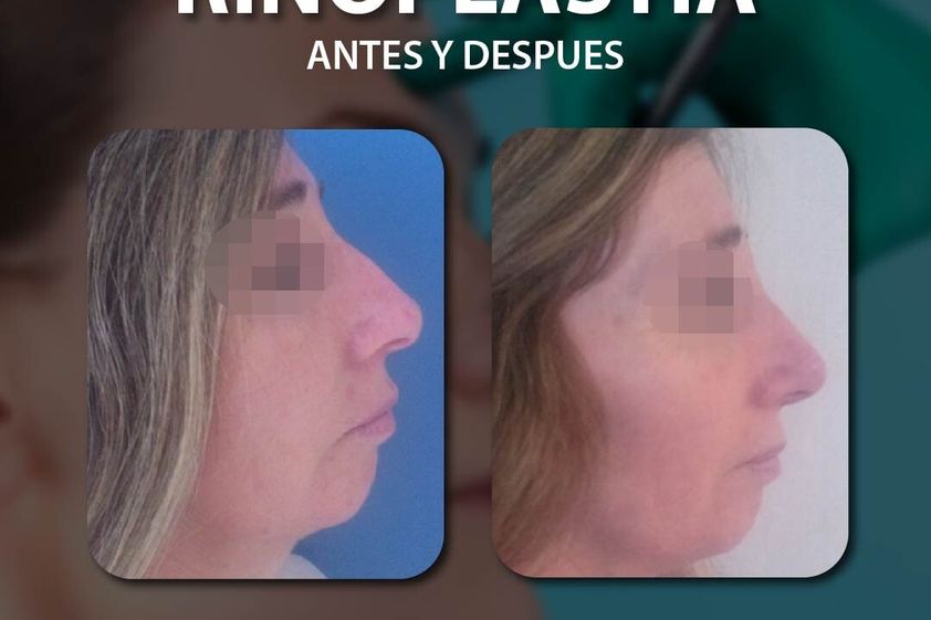 Rinoplastia antes y después - 844507