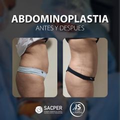 Abdominoplastia - Dr. José María Schiavoni