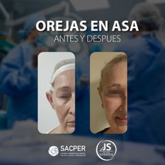 Otoplastia - Dr. José María Schiavoni