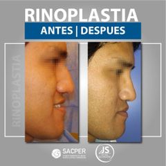 Rinoplastia - Dr. José María Schiavoni