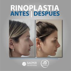 Rinoplastia - Dr. José María Schiavoni