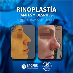 Rinoplastia - Dr. José María Schiavoni