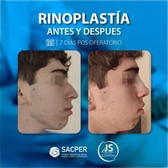 Rinoplastia - Dr. José María Schiavoni