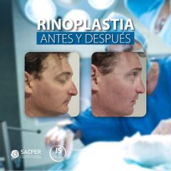 Rinoplastia - Dr. José María Schiavoni