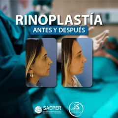 Rinoplastia - Dr. José María Schiavoni