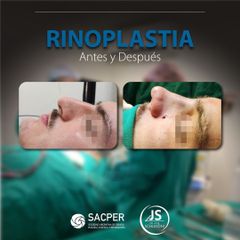 Rinoplastia - Dr. José María Schiavoni