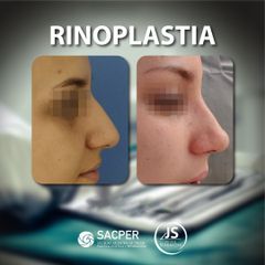 Rinoplastia - Dr. José María Schiavoni