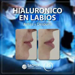 Relleno de labios - Dr. José María Schiavoni