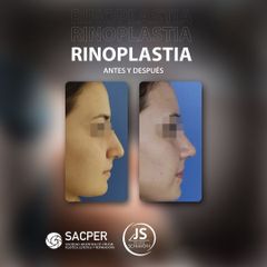 Rinoplastia - Dr. José María Schiavoni