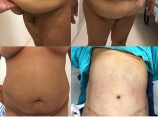 ABDOMINOPLASTIA DR. MAYER Y DRA. LAMBOIS
