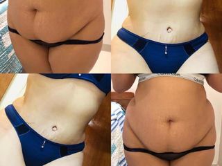 ABDOMINOPLASTIA DR. MAYER Y DRA. LAMBOIS