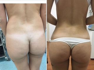 AUMENTO GLÚTEO  LIPOESCULTURA/LIPOTRANSFERENCIA