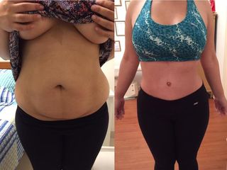 ABDOMINOPLASTIA DR. MAYER Y DRA. LAMBOIS
