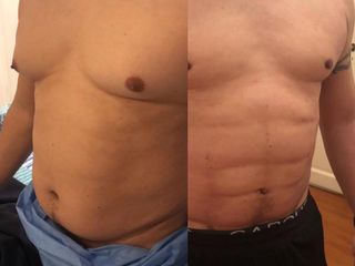 Marcación abdominal 