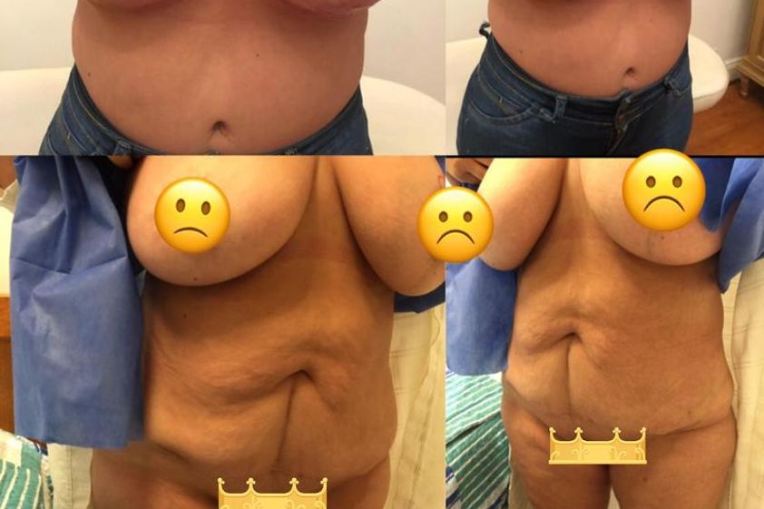 Abdominoplastía antes y después - 632333