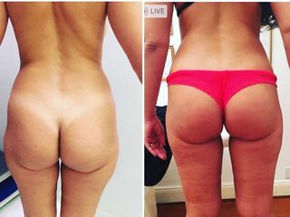 LIPOESCULTURA DR. MAYER Y DRA. LAMBOIS