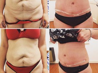 ABDOMINOPLASTIA DR. MAYER Y DRA. LAMBOIS