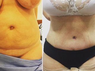 ABDOMINOPLASTIA DR. MAYER Y DRA. LAMBOIS
