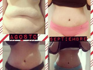 ABDOMINOPLASTIA DR. MAYER Y DRA. LAMBOIS