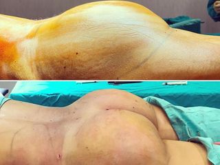 AUMENTO GLÚTEO  LIPOESCULTURA/LIPOTRANSFERENCIA