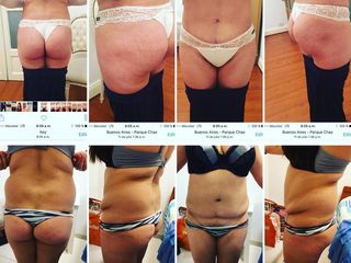 LIPOSUCCIÓN DR. MAYER Y DRA. LAMBOIS