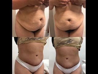 Dermolipectomía - Dr. Diego Mayer y Dra. Sabrina Lambois