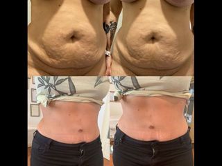 Dermolipectomía - Dr. Diego Mayer y Dra. Sabrina Lambois