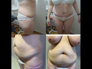 Dermolipectomía - Dr. Diego Mayer y Dra. Sabrina Lambois