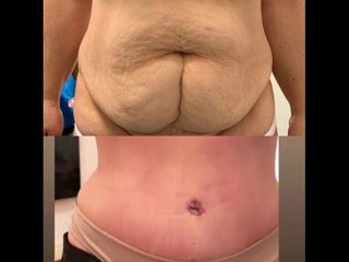 Dermolipectomía - Dr. Diego Mayer y Dra. Sabrina Lambois