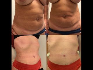 Dermolipectomía - Dr. Diego Mayer y Dra. Sabrina Lambois