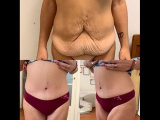 Dermolipectomía - Dr. Diego Mayer y Dra. Sabrina Lambois