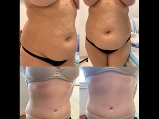 Dermolipectomía - Dr. Diego Mayer y Dra. Sabrina Lambois