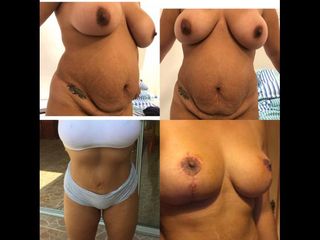 Dermolipectomía - Dr. Diego Mayer y Dra. Sabrina Lambois