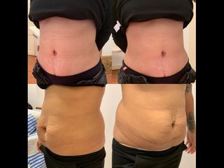 Dermolipectomía - Dr. Diego Mayer y Dra. Sabrina Lambois