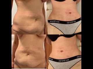 Dermolipectomía - Dr. Diego Mayer y Dra. Sabrina Lambois