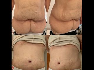 Dermolipectomía - Dr. Diego Mayer y Dra. Sabrina Lambois