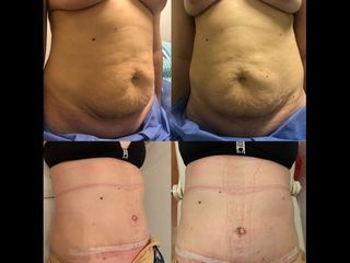 Dermolipectomía - Dr. Diego Mayer y Dra. Sabrina Lambois