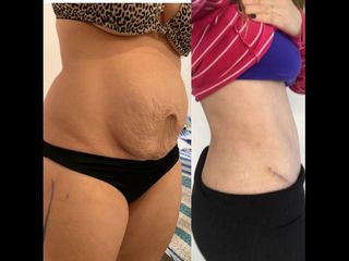 Dermolipectomía - Dr. Diego Mayer y Dra. Sabrina Lambois