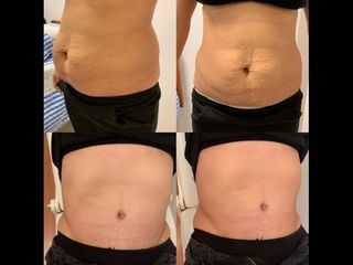 Dermolipectomía - Dr. Diego Mayer y Dra. Sabrina Lambois