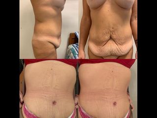 Dermolipectomía - Dr. Diego Mayer y Dra. Sabrina Lambois