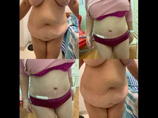 Dermolipectomía - Dr. Diego Mayer y Dra. Sabrina Lambois