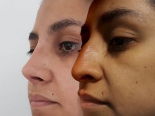 Rinoplastia Estética 