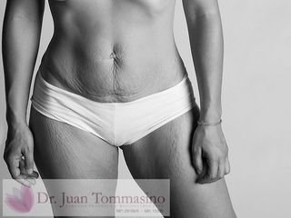 ABDOMINOPLASTIA 