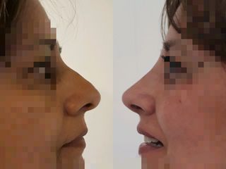 Rinoplastia Estética 