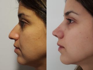 Rinoplastia Estética 