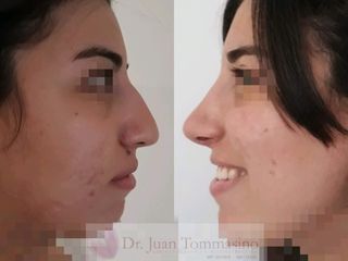 Rinoplastia Estética 