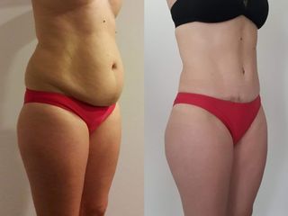 LIPOABDOMINOPLASTIA 