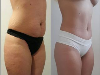 LIPOABDOMINOPLASTIA 