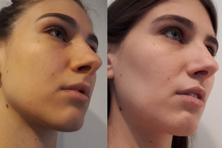 Bichectomia antes y después - 630568