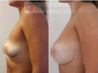 Aumento de volumen mamario con implantes